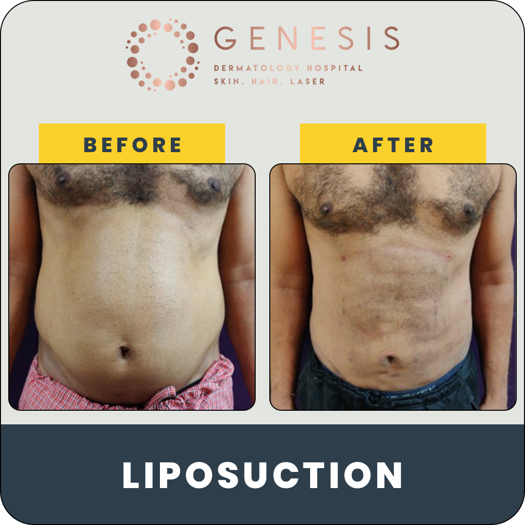 liposuction 2